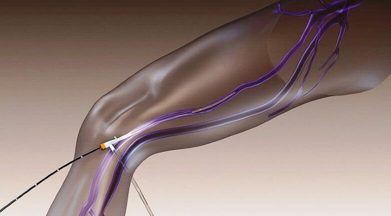 Obteración por radiofrecuencia - un método de tratamento de varices